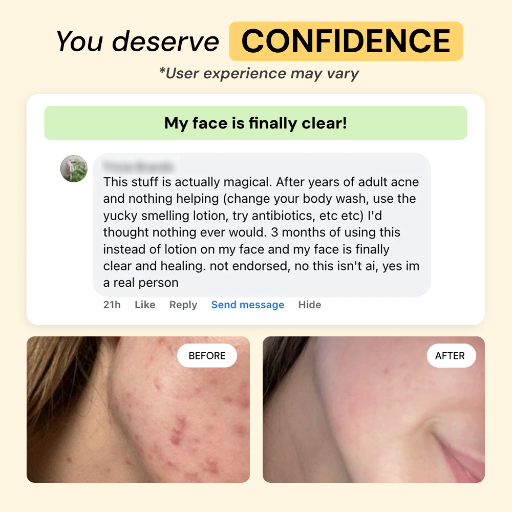 2-Step Acne Routine — view 7