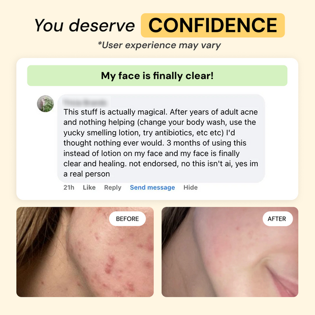 Customer photo and message about 2-Step Acne Routine