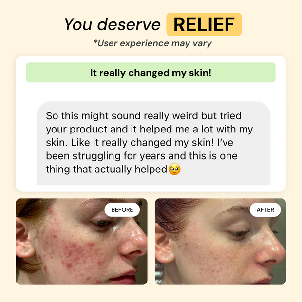 Customer photo and message about 2-Step Acne Routine